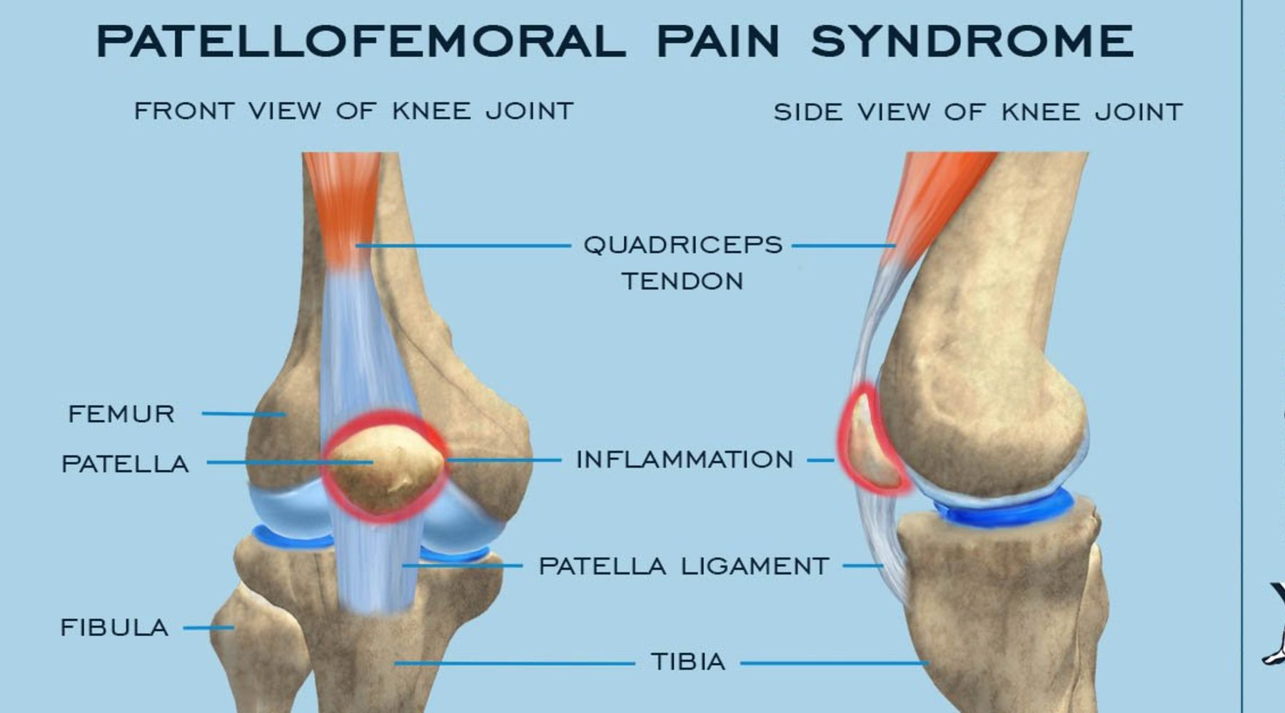 Weak in the knee? Maybe it's patellofemoral syndrome. – Earth Fed Muscle